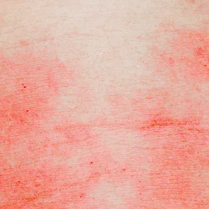 Article - Eczema Skin